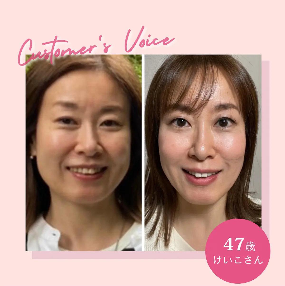 47歳 けいこさん ビフォーアフター