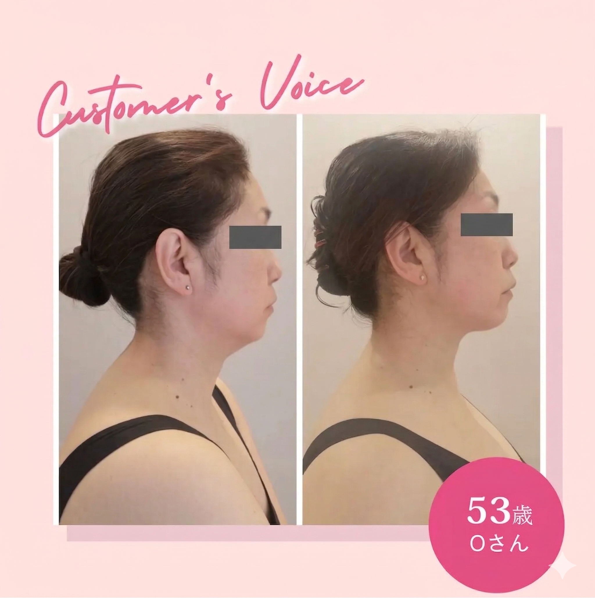 53歳 Oさん ビフォーアフター